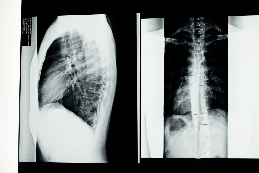 osteochondroza odcinka szyjnego kręgosłupa na zdjęciu