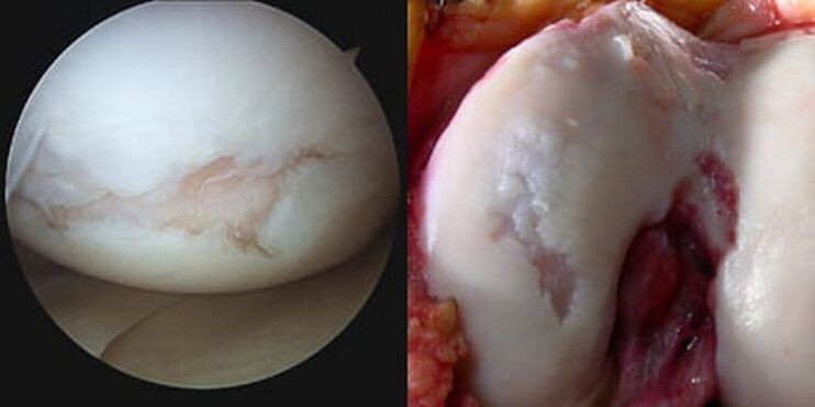 uszkodzenie stawu kolanowego jest widoczne podczas operacji