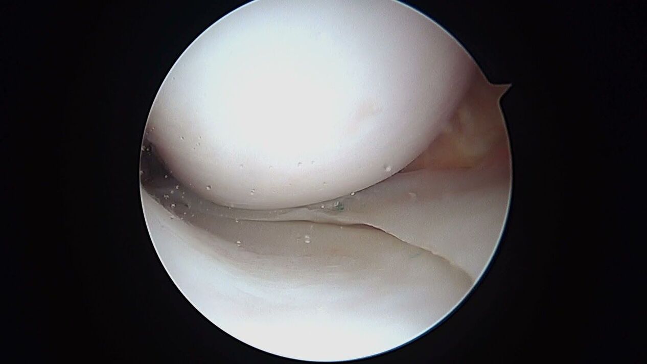 widok stawu kolanowego przez artroskop