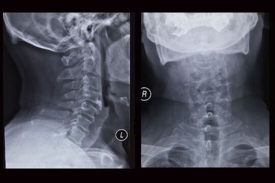 Zdjęcie rentgenowskie kręgosłupa szyjnego (pacjentka ma osteochondrozę)