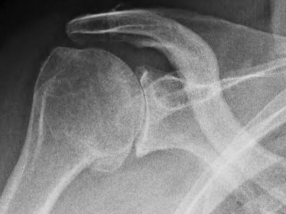 Zdjęcie rentgenowskie stawu barkowego dotkniętego chorobą zwyrodnieniową stawów