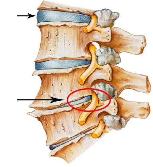 Osteochondroza szyjka macicy