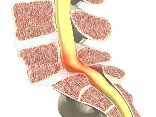 Segment krwi dla osteochondrozy
