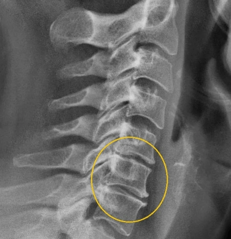 osteochondroza szyjna