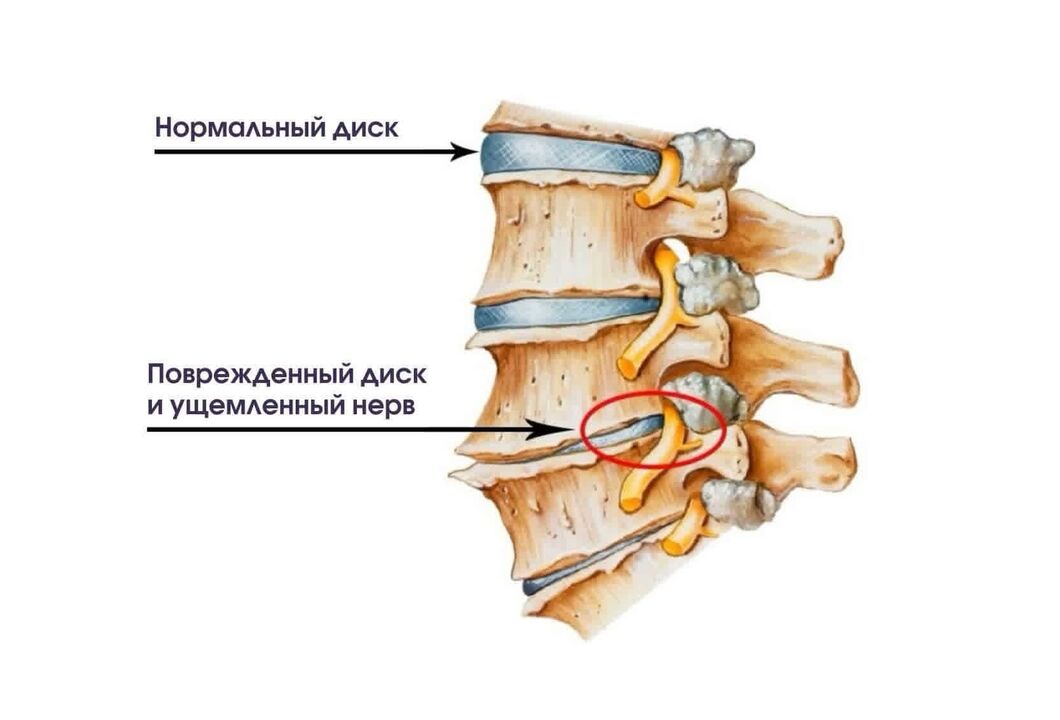 Objawy osteochondrozy szyjnej
