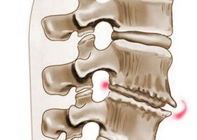 uszkodzenie kręgów w osteochondrozie klatki piersiowej