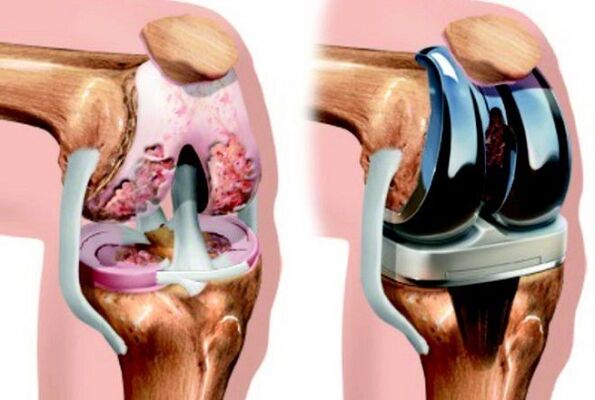 przed i po artrozie stawu kolanowego z powodu artrozy