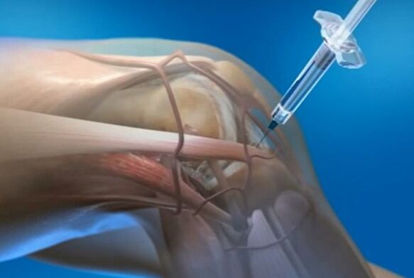zastrzyki dostawowe w przypadku artrozy stawu kolanowego